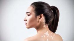 Vitiligo Penyakit Apa, Timbulkan Kelainan pada Kulit Bikin Tak Percaya Diri  