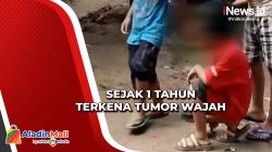 Kisah Inspiratif Bocah di Pandeglang Tetap Semangat Sekolah meski Terserang Penyakit Tumor di Wajah