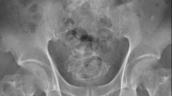  Waduh Lansia Ini Masukkan Tali 2 Meter ke dalam Penis, Begini Akibatnya <