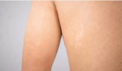 Ini 5 Cara Menghilangkan Panu Sampai ke Akarnya, Bisa Menggunakan Kunyit hingga Lidah Buaya