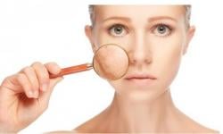 10 Cara Menghilangkan Panu di Wajah, Nomor 7 Jarang Diketahui Orang