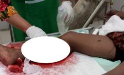 Buaya Serang Manusia di Bangka Barat, Kaki Warga Banten Ini Nyaris Putus
