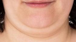 Tak Perlu Keluar Biaya, Begini 3 Cara Menghilangkan Double Chin dengan Mudah