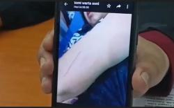 Gegara Tak Pakai Jilbab, Mahasiswi di Palembang Dianiaya Pacar Pakai Pisau Cutter<