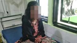 Apes, 2 Warga Batang Diserang Tawon hingga Wajah Bengkak