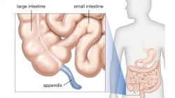 Kenali Tanda-tanda Awal Usus Buntu, Nyeri Perut Kanan Bisa Jadi Tanda Awal