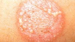 5 Cara Mudah Menghilangkan Kurap dengan Cepat Dalam 1 Hari, Simak Tips Berikut Ini!