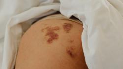 3 Cara Menghilangkan Tanda Lahir yang Banyak Dipilih, Apa Saja?