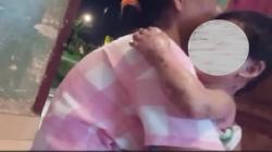 Tragis, Balita di Muba Tersiram Bubur Panas  saat Ditinggal Ibu Mandi