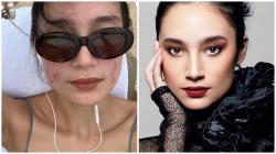 Tatjana Saphira Ungkap Pernah Depresi Gara-gara Jerawat: Aku Enggak Pengen Keluar Rumah dan Ketemu Orang