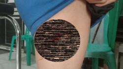 3 Anak Digigit Anjing Rabies di Dompu, 1 Korban Luka di Wajah