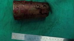 Mabuk, Pria Ini Masukkan Gelas 12 Cm ke Bokong demi Kepuasan Seksual