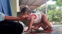 Operasi Bayi Kembar Siam Berkaki 6 di NTB Diperkirakan Butuh Waktu 11,5 Jam<