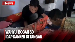 Bocah 7 Tahun di Palangka Raya  Tak Bisa Sekolah, Idap Kanker Otot di Tangan