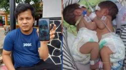RSHS Bandung Laksanakan Operasi Pemisahan Bayi Kembar Siam Hasan-Husen asal Subang<
