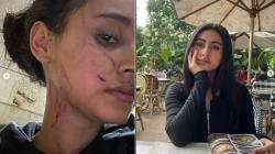 Dianiaya Mantan Pacar Suami hingga Babak Belur, Begini Kondisi Selebgram Afifah Riyad 