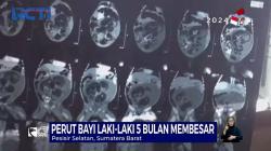Heboh Bayi Lelaki Berusia 5 Bulan Hamil, Isinya Janin Kembarannya