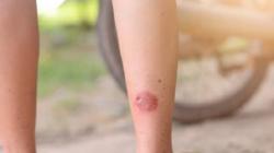 4 Cara Mengatasi Kaki Kena Knalpot, Jangan Oleskan Odol