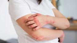  Cara Menghilangkan Kurap Sampai ke Akar secara Alami, Gampang Banget