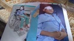 Bocah SD di Jombang Buta Permanen, Terkena Patahan Kayu saat Temannya Main Bola<