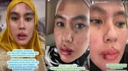 Sempat Menderita Penyakit Aneh, Begini Kondisi Kartika Putri Sekarang 