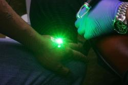 Hapus Tato Gratis dengan Laser