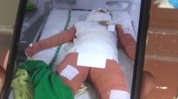 Ngeri! Perempuan di Deliserdang Dibakar Hidup-Hidup Eks Karyawan, Kondisinya Memilukan<