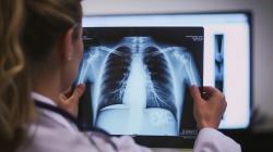 Bakteri Pemakan Daging Juga Ditemukan di AS, Gejalanya Muntah hingga Sesak Napas