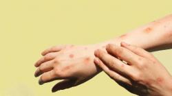 Waspada, Gonta-ganti Pasangan dan Seks Sesama Jenis Sumber Penularan Cacar Monyet Mpox