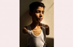Foto Bocah Gaza Kehilangan 2 Tangan Menangkan Penghargaan World Press Photo 2025