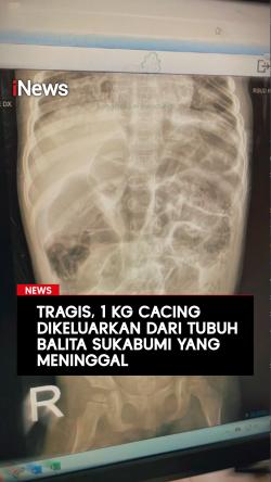 1 Kg Cacing Dikeluarkan dari Tubuh Balita Sukabumi yang Meninggal