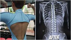 Kondisi Terkini Nada Anak Deddy Corbuzier usai Operasi Skoliosis, Sempat Tidak Bisa Duduk