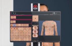 Ancaman Sinar UV, Teknologi AI Bisa Deteksi Dini Kanker Kulit