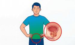 Jangan Salah Kaprah! Ini Hubungan Ejakulasi Rutin dan Risiko Kanker Prostat