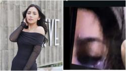 Rachel Vennya Diduga Alami Kekerasan Fisik hingga Mata Bonyok, Faktanya Mengejutkan!