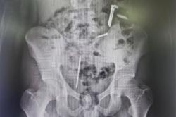 Ngeri! Paku hingga Koin Ditemukan dalam Tubuh Remaja asal Jember, kok Bisa?<