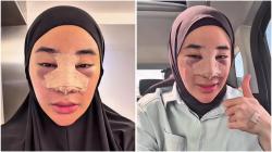 Viral Clara Shinta Oplas Hidung di Thailand, Ini Fotonya!