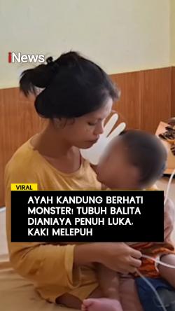  Ayah Kandung Berhati Monster! Tubuh Balita Dianiaya Punuh Luka, Kaki Melepuh