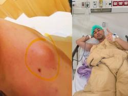 Apa Itu Lipoma, Benjolan yang Diduga Ada di Bahu Raffi Ahmad?