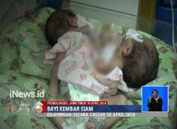 Bayi Kembar Siam Hanya Miliki Sepasang Kaki dan 1 Jantung Lahir di Probolinggo