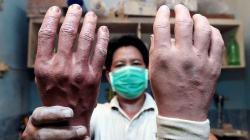 Melihat Proses Pembuatan Kaki dan Tangan Palsu