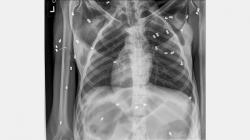 Orangutan Sumatera Ditemukan Luka Parah, Tubuh Dipenuhi 74 Peluru