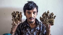 Kutil di Jari Terus Tumbuh, Pria Bangladesh Minta Kedua Tangan Diamputasi