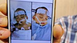 Bayi Kembar Siam di Sumatera Utara Berhasil Dipisahkan, Begini Kondisinya