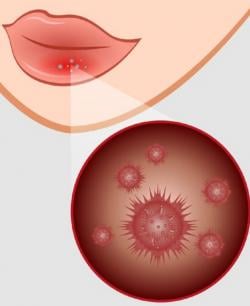 Cara Mengobati Herpes Simpleks dan Herpes Zooster