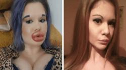 Gelar Bibir Terbesar di Dunia Belum Cukup, Gadis Ini Akan Suntik Filler ke-27 Kali Agar Mirip Boneka