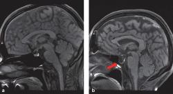 Empty Sella Syndrome, Kelainan Langka yang Menyerang Otak Ruben Onsu, Penyakit apa Itu?