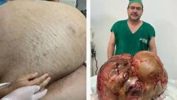 Penampakan Tumor Raksasa Seberat 45 Kg yang Diangkat dari Perut Wanita di Brasil