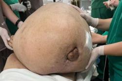 Dokter Bedah Syok, Menemukan Tumor Raksasa Seberat 45 Kilogram Bersarang dalam Perut Seorang Wanita