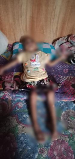 Miris, Balita Penderita Down Syndrome di Kasui Butuh Uluran Tangan Dermawan